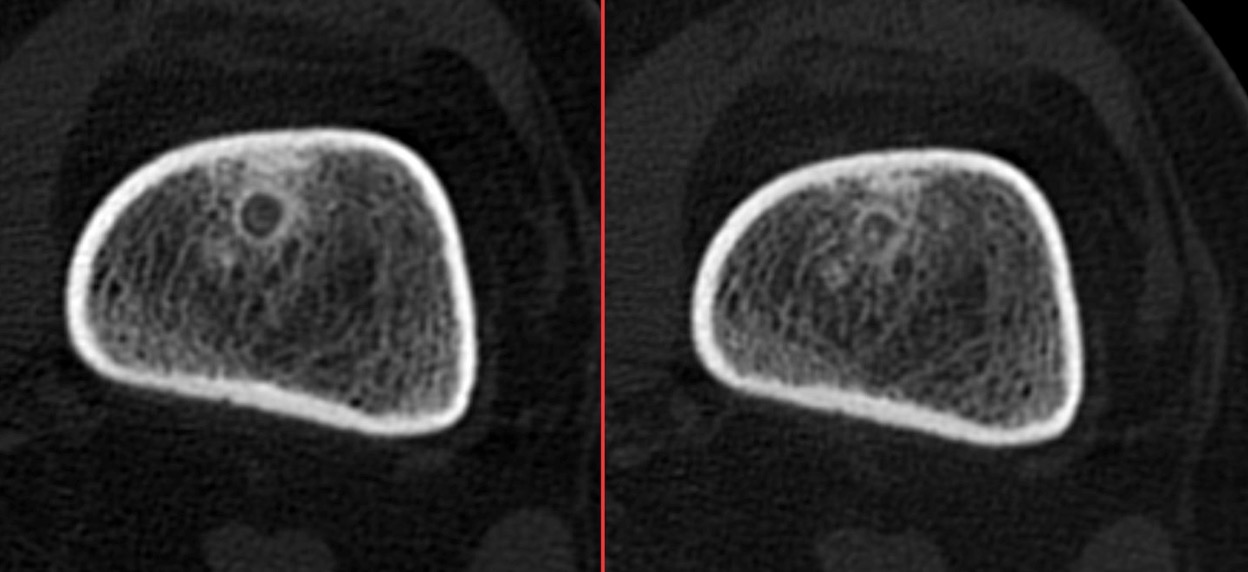 Figure 2 for case osteoid osteoma ( RID4005 )